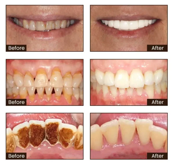LOVILDS™ Nicotinamide Whitening Toothpaste