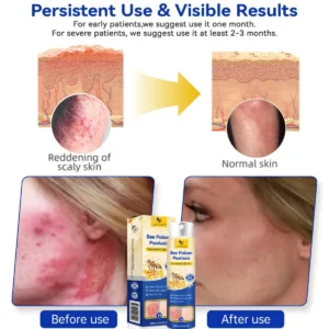 LOVILDS™ PsoriaHeal psoriasis Spray