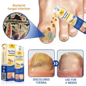 LOVILDS™ PsoriaHeal psoriasis Spray