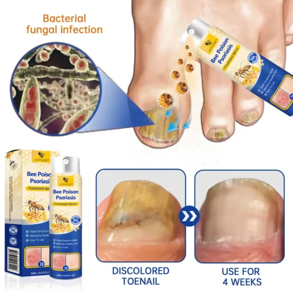LOVILDS™ PsoriaHeal psoriasis Spray