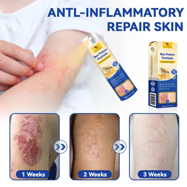 LOVILDS™ PsoriaHeal psoriasis Spray