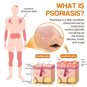 LOVILDS™ PsoriaHeal psoriasis Spray