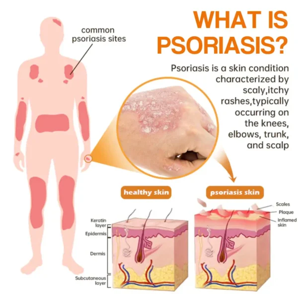 LOVILDS™ PsoriaHeal psoriasis Spray