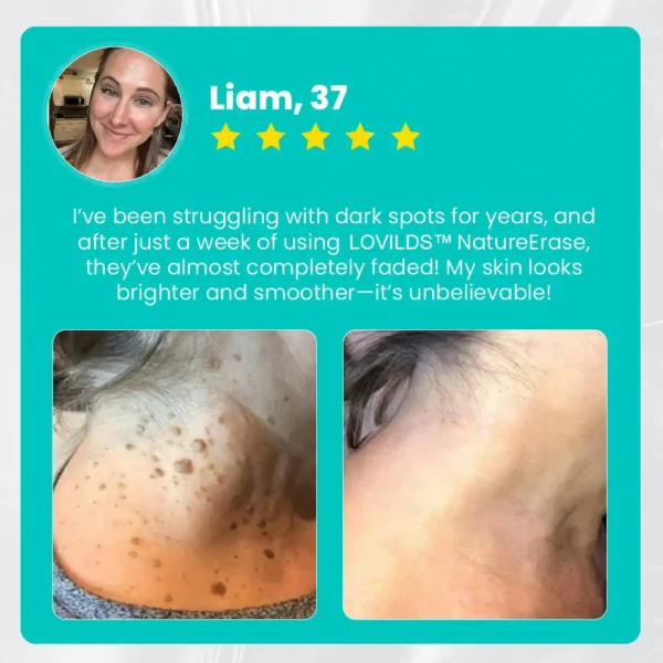 LOVILDS™ Ultra NatureErase Instant Mole & Spot Removal Gel