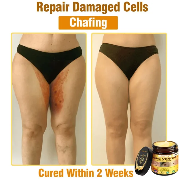 𝐋𝐎𝐕𝐈𝐋𝐃𝐒™ 𝐁𝐞𝐞 𝐕𝐞𝐧𝐨𝐦 𝐀𝐥𝐥-𝐢𝐧-𝐎𝐧𝐞 𝐂𝐫𝐞𝐚𝐦–🌸 Anti-aging,Hydrating, Skin Repair, Even Tone, Acne and Dark Spot Treatment, Wart and Mole Removal, Psoriasis Relief
