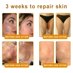 𝐋𝐎𝐕𝐈𝐋𝐃𝐒™ 𝐁𝐞𝐞 𝐕𝐞𝐧𝐨𝐦 𝐀𝐥𝐥-𝐢𝐧-𝐎𝐧𝐞 𝐂𝐫𝐞𝐚𝐦–🌸 Anti-aging,Hydrating, Skin Repair, Even Tone, Acne and Dark Spot Treatment, Wart and Mole Removal, Psoriasis Relief