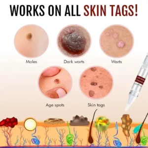 🔥 🔥🔥Final 3 Hours: 60% OFF Lovilds™ Tags & Moles Remover