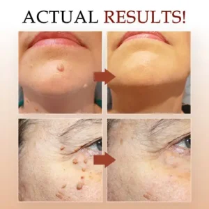 🔥 🔥🔥Final 3 Hours: 60% OFF Lovilds™ Tags & Moles Remover