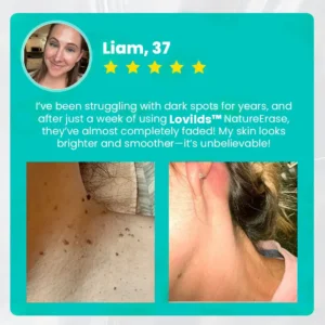 ✅ Official Store: Lovilds™ PRO NatureErase Instant Mole & Spot Removal Gel