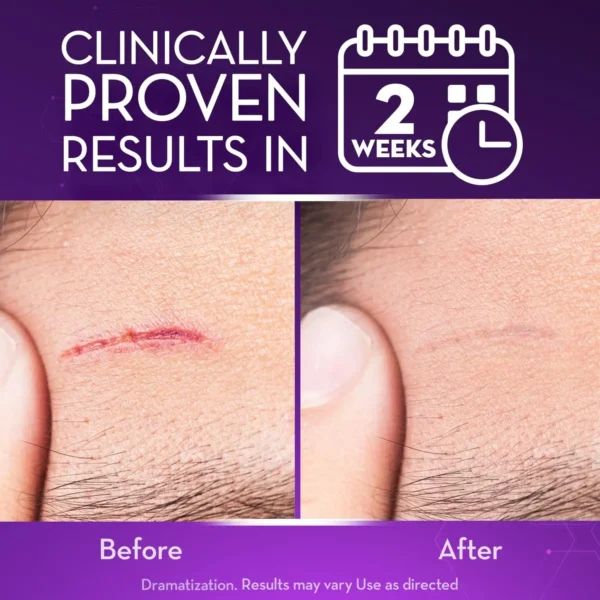 LOVILDS® Advanced Scar Gel