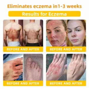 LOVILDS™ Bee Toxin Skin Repair Cream(AAD Recommended👨‍⚕️)