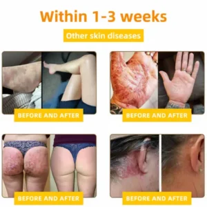 LOVILDS™ Bee Toxin Skin Repair Cream(AAD Recommended👨‍⚕️)
