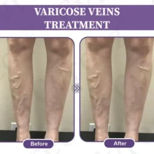 LOVILDS™ Care Phyto Cream-HelpsTreat Varicose Veins,Swelling,cramps and Leg Pain