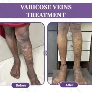 LOVILDS™ Care Phyto Cream-HelpsTreat Varicose Veins,Swelling,cramps and Leg Pain