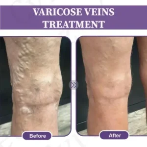 LOVILDS™ Care Phyto Cream-HelpsTreat Varicose Veins,Swelling,cramps and Leg Pain
