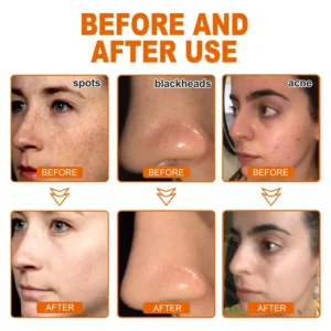 LOVILDS™ Herbal Spots Peel-Off Facial Mask