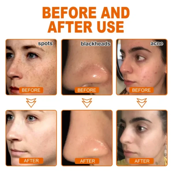 LOVILDS™ Herbal Spots Peel-Off Facial Mask
