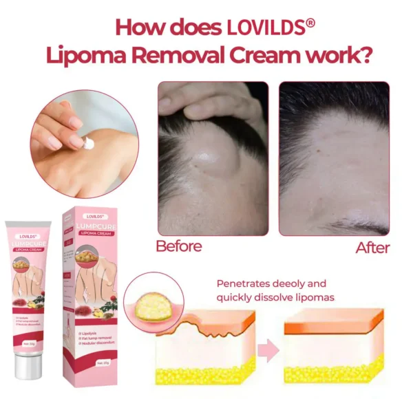 LOVILDS® LumpCure Lipoma Cream 🔥 SUMMER SALE 60%