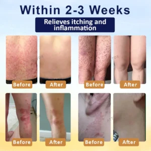 LOVILDS™ Psoriasis Care Mellifera Venom Skin Healing Spray🐝〰️