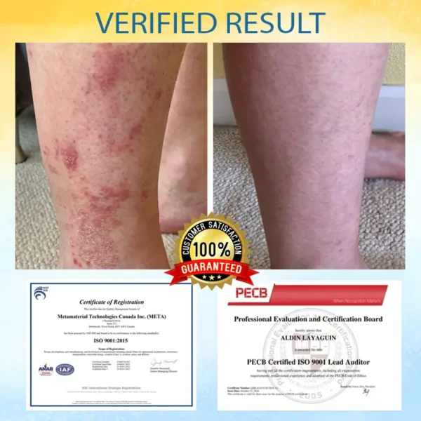 LOVILDS™ Psoriasis Care Mellifera Venom Skin Healing Spray🐝〰️