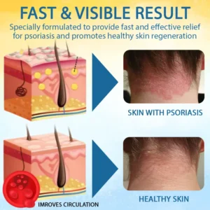 LOVILDS™ Psoriasis Care Mellifera Venom Skin Healing Spray🐝〰️