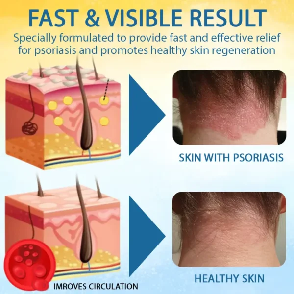 LOVILDS™ Psoriasis Care Mellifera Venom Skin Healing Spray🐝〰️