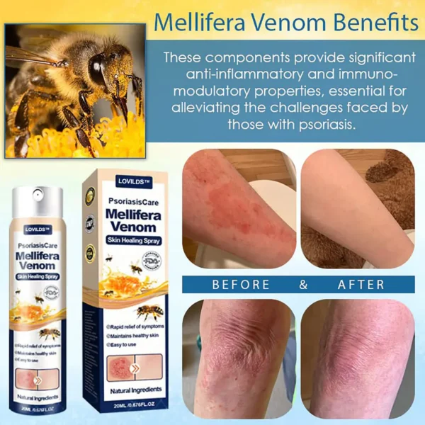 LOVILDS™ Psoriasis Care Mellifera Venom Skin Healing Spray🐝〰️