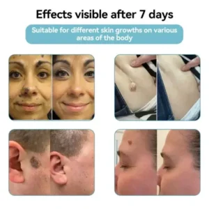 LOVILDS® VelvetSkin+ All-in-One Laser Eraser Pen