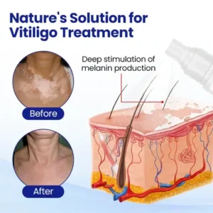 Lovilds® Evenora Vitiligo Herbal Spray