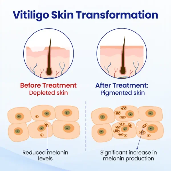 Lovilds® Evenora Vitiligo Herbal Spray