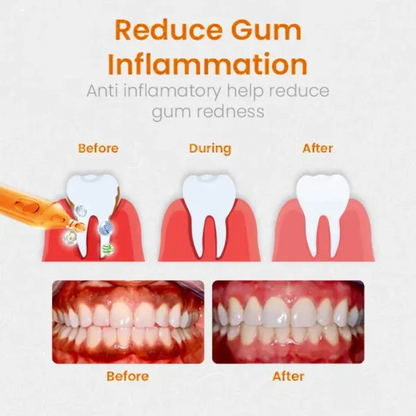 [Official Brand Store] LOVILDS™ Gum Repair Treatment Ampoules