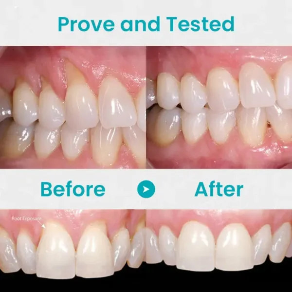 [Official Brand Store] LOVILDS™ Gum Repair Treatment Ampoules