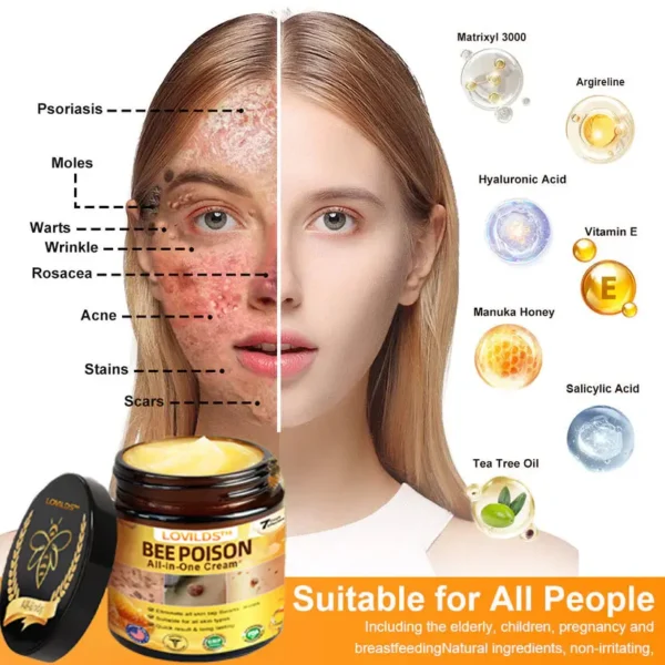 [𝐎𝐟𝐟𝐢𝐜𝐢𝐚𝐥 𝐁𝐫𝐚𝐧𝐝 𝐒𝐭𝐨𝐫𝐞] 🐝 LOVILDS™ 𝐁𝐞𝐞 𝐕𝐞𝐧𝐨𝐦 𝐀𝐥𝐥-𝐢𝐧-𝐎𝐧𝐞 𝐂𝐫𝐞𝐚𝐦 (👩‍⚕️ 𝐀𝐦𝐞𝐫𝐢𝐜𝐚𝐧 𝐀𝐜𝐚𝐝𝐞𝐦𝐲 𝐨𝐟 𝐃𝐞𝐫𝐦𝐚𝐭𝐨𝐥𝐨𝐠𝐲 𝟐𝟎𝟐𝟓 𝐒𝐩𝐞𝐜𝐢𝐚𝐥𝐥𝐲 𝐑𝐞𝐜𝐨𝐦𝐦𝐞𝐧𝐝𝐞𝐝 𝐏𝐫𝐨𝐝𝐮𝐜𝐭)