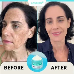 Final Hours—Sale Ending Soon!💥LOVILDS* Renewal Skin Cream | Spot Removal & Skin Renewal for Dark Spots, Age Spots, and Sun Spots* Daily Firming for All Skin Types