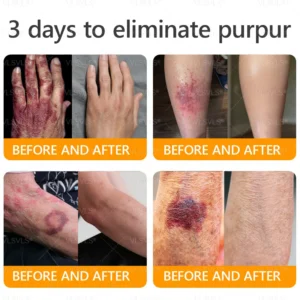 LOVILDS™ 𝘽𝙀𝙀 𝙑𝙀𝙉𝙊𝙈 𝑺𝒌𝒊𝒏 𝑹𝒆𝒔𝒕𝒐𝒓𝒂𝒕𝒊𝒐𝒏 𝑪𝒓𝒆𝒂𝒎 –🐝 Anti-aging,Hydrating, Skin Repair, Even Tone, Acne and Dark Spot Treatment, Wart and Mole Removal, Psoriasis Relief