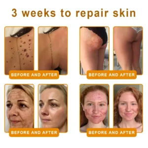 LOVILDS™ 𝘽𝙀𝙀 𝙑𝙀𝙉𝙊𝙈 𝑺𝒌𝒊𝒏 𝑹𝒆𝒔𝒕𝒐𝒓𝒂𝒕𝒊𝒐𝒏 𝑪𝒓𝒆𝒂𝒎 –🐝 Anti-aging,Hydrating, Skin Repair, Even Tone, Acne and Dark Spot Treatment, Wart and Mole Removal, Psoriasis Relief