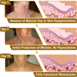LOVILDS™ BeeVenom Vitiligo Treatment Cream (🔥80% Off for a Limited Time!)