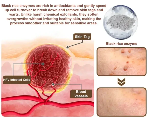 LOVILDS® Black Rice Skin Repair Essence Cream 👨‍⚕️ MHRA Certified (Removes warts and skin growths, improves keratin buildup and seborrheic dermatitis, follicular keratosis, skin cancer, and age spots)