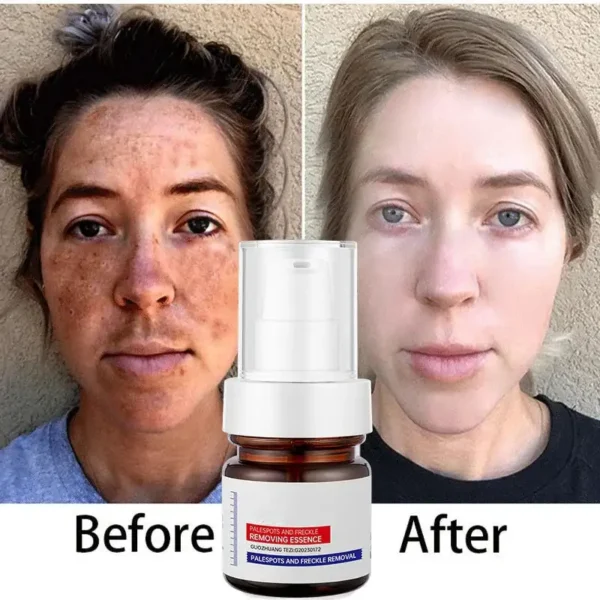 LOVILDS™  WHITENING ANDFRECKLE REMOVING ESSENCE