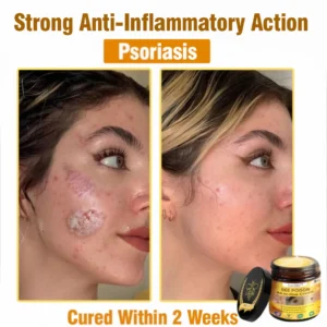 [Official Brand Store] 🏆Lovilds™ BEE POISON All-in-One Cream (✅FDA Approved & Mayo Clinic Recommended)