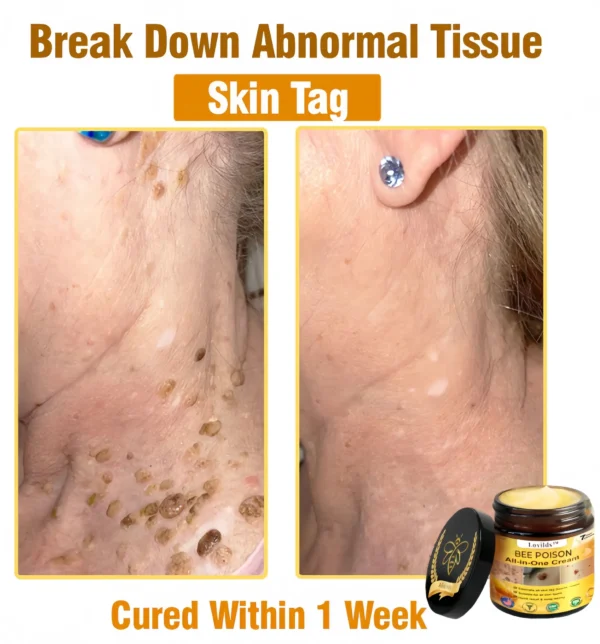 [Official Brand Store] 🏆Lovilds™ BEE POISON All-in-One Cream (✅FDA Approved & Mayo Clinic Recommended)