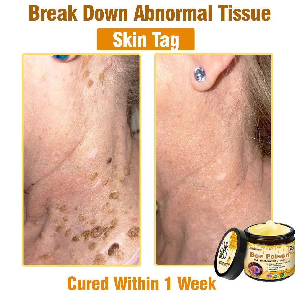 ✨FDA Approved:LOVILDS™ Bee Poison Skin Restoration Cream — 🔥Limited Time 70% OFF🔥