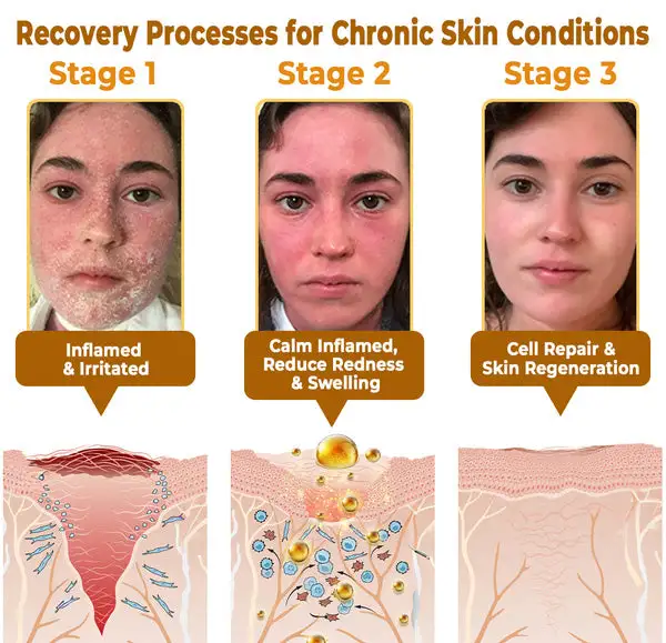 ✨FDA Approved:LOVILDS™ Bee Poison Skin Restoration Cream — 🔥Limited Time 70% OFF🔥