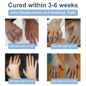 FDA Certified: LOVILDS® Black Rice Pain Healing Bone Cream ( Treatment for Arthritis, Rheumatic Diseases, Osteoarthritis, Neuropathyy Muscle Spasms and Cramps, Sports Injuries)