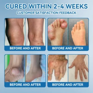 LOVILDSยฎ ๐๐๐-๐๐๐ ๐๐จ๐ข๐ง๐ญ ๐๐๐๐ฅ๐ข๐ง๐ ๐๐ซ๐๐๐ฆ ๐๐ซ๐๐๐ญ๐ฌ ๐๐ซ๐ญ๐ก๐ซ๐ข๐ญ๐ข๐ฌ, ๐๐๐ฎ๐ซ๐จ๐ฉ๐๐ญ๐ก๐ฒ, ๐๐ก๐๐ฎ๐ฆ๐๐ญ๐ข๐ฌ๐ฆ, ๐๐ฉ๐จ๐ซ๐ญ๐ฌ ๐๐ง๐ฃ๐ฎ๐ซ๐ข๐๐ฌ & ๐๐จ๐ซ๐