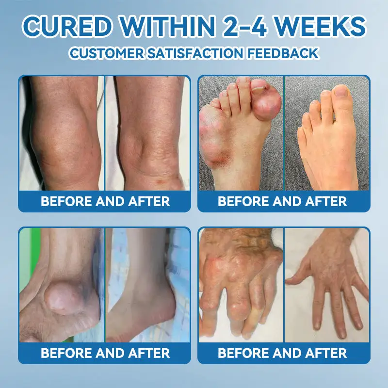 LOVILDSยฎ ๐๐๐-๐๐๐ ๐๐จ๐ข๐ง๐ญ ๐๐๐๐ฅ๐ข๐ง๐ ๐๐ซ๐๐๐ฆ ๐๐ซ๐๐๐ญ๐ฌ ๐๐ซ๐ญ๐ก๐ซ๐ข๐ญ๐ข๐ฌ, ๐๐๐ฎ๐ซ๐จ๐ฉ๐๐ญ๐ก๐ฒ, ๐๐ก๐๐ฎ๐ฆ๐๐ญ๐ข๐ฌ๐ฆ, ๐๐ฉ๐จ๐ซ๐ญ๐ฌ ๐๐ง๐ฃ๐ฎ๐ซ๐ข๐๐ฌ & ๐๐จ๐ซ๐