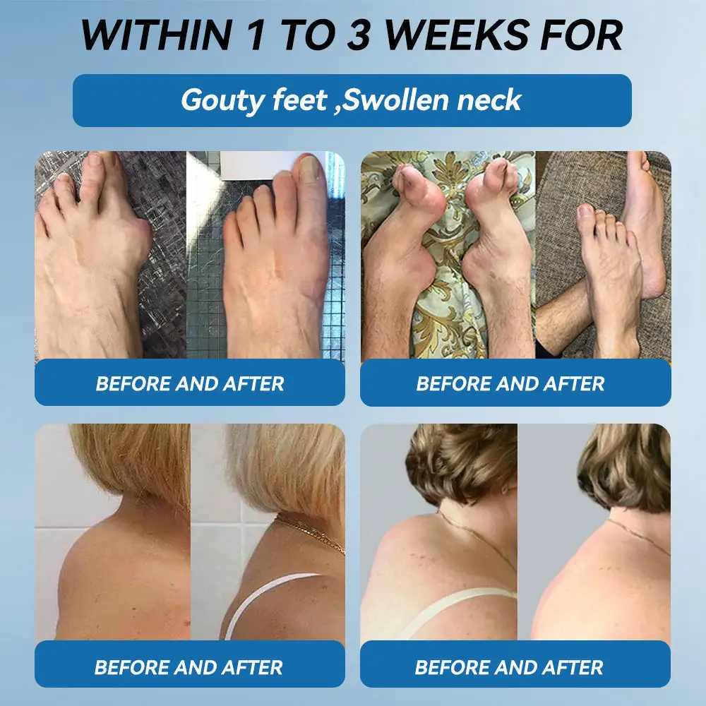 LOVILDSยฎ ๐๐๐-๐๐๐ ๐๐จ๐ข๐ง๐ญ ๐๐๐๐ฅ๐ข๐ง๐ ๐๐ซ๐๐๐ฆ ๐๐ซ๐๐๐ญ๐ฌ ๐๐ซ๐ญ๐ก๐ซ๐ข๐ญ๐ข๐ฌ, ๐๐๐ฎ๐ซ๐จ๐ฉ๐๐ญ๐ก๐ฒ, ๐๐ก๐๐ฎ๐ฆ๐๐ญ๐ข๐ฌ๐ฆ, ๐๐ฉ๐จ๐ซ๐ญ๐ฌ ๐๐ง๐ฃ๐ฎ๐ซ๐ข๐๐ฌ & ๐๐จ๐ซ๐