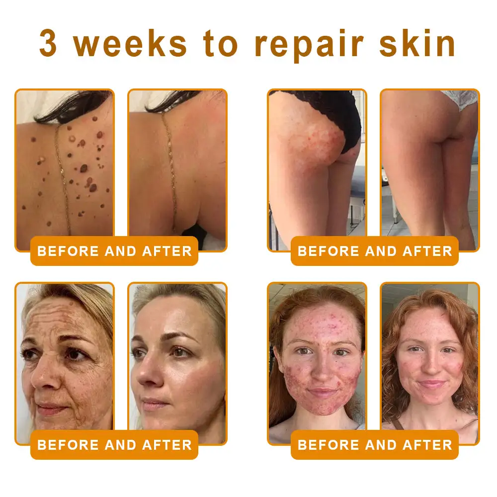 LOVILDS™ 𝘽𝙀𝙀 𝙑𝙀𝙉𝙊𝙈 𝑺𝒌𝒊𝒏 𝑹𝒆𝒔𝒕𝒐𝒓𝒂𝒕𝒊𝒐𝒏 𝑪𝒓𝒆𝒂𝒎 –🌸 Anti-aging,Hydrating, Skin Repair, Even Tone, Acne and Dark Spot Treatment, Wart and Mole Removal, Psoriasis Relief