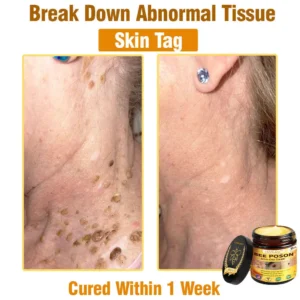 LOVILDS™ BEE POSON All-in-One Cream US Dermatologist Approved