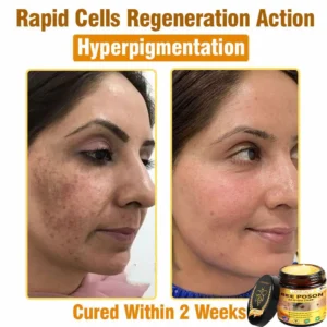 LOVILDS™ BEE POSON All-in-One Cream US Dermatologist Approved